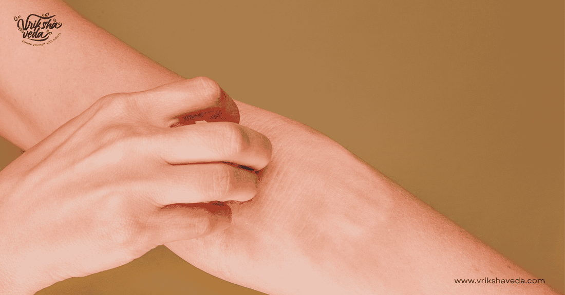 Natural Relief for Heat Rashes and Sun Irritations: Ayurvedic Remedies for Summer Skin