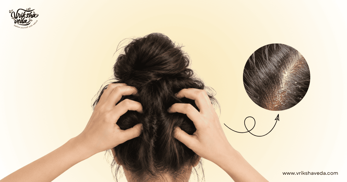 Soothing Scalp Psoriasis & Eczema Naturally