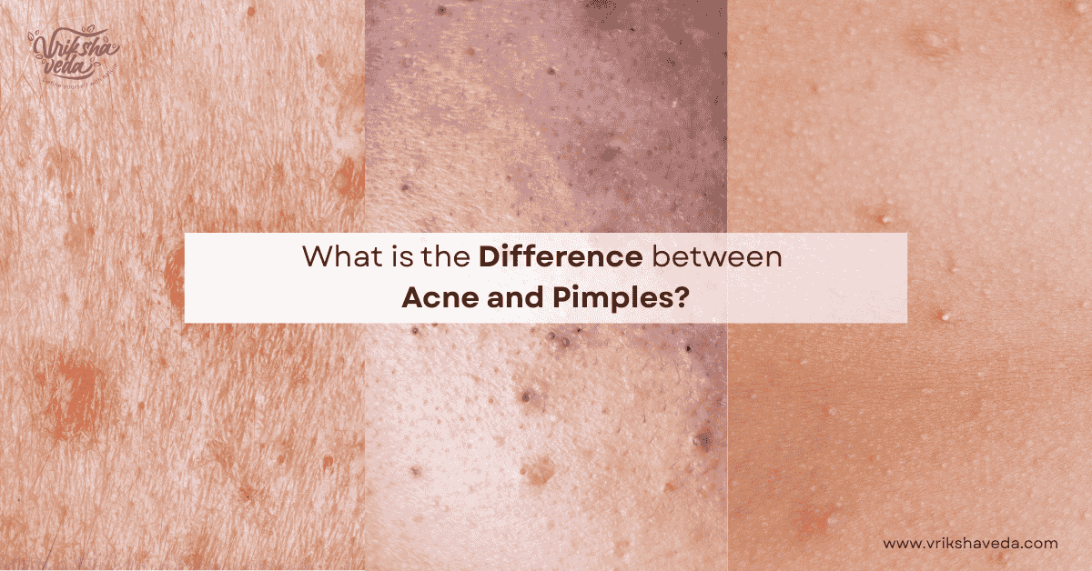 What is the Difference between Acne and Pimples?